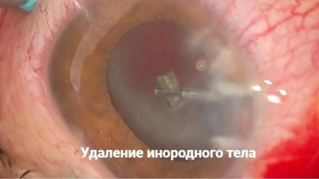 Уфимские офтальмологи спасли зрение ребенку с критической инфекцией после травмы глаза